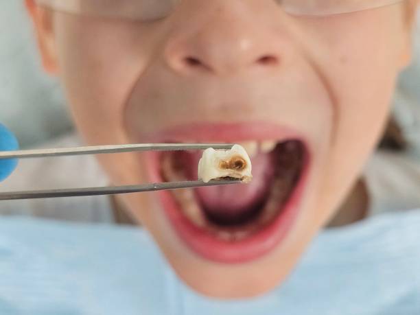 Best Emergency Wisdom Teeth Removal in Vaeboro, NC